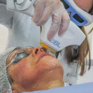 cliniderma bbl facial